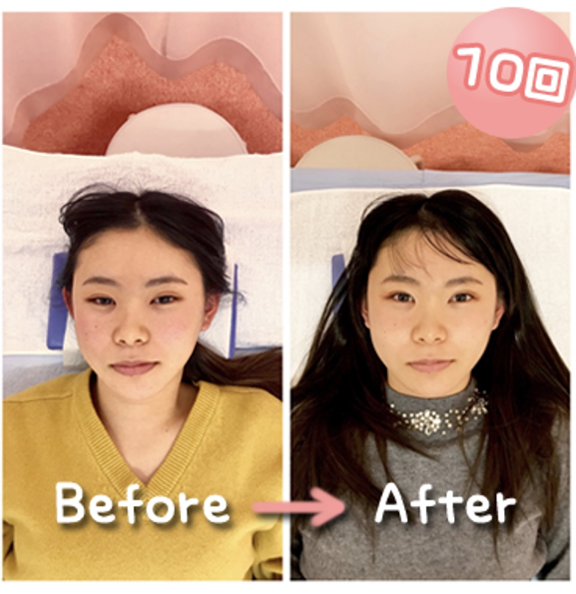 美容鍼 寝屋川市たぶし鍼灸整骨院